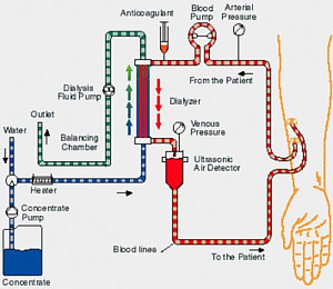 hemodialysis.jpg